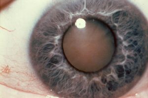 Closeup of Cataract Surgery in Miami