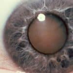 Cataract Eye