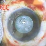 Image of a dense cataract