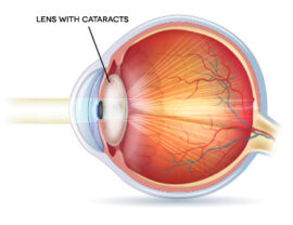 Premium Cataract Surgery in Boca Raton, Miami, Fort Lauderdale, Palm Beach, Plantation, and Weston