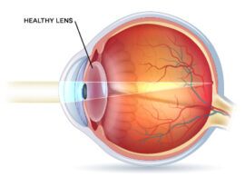 Multifocal Lens Options for Residents of Boca Raton, Miami, Davie, Palm Beach, Fort Lauderdale, and Weston