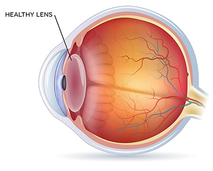 Healthy Lens Medical Eye Illustration