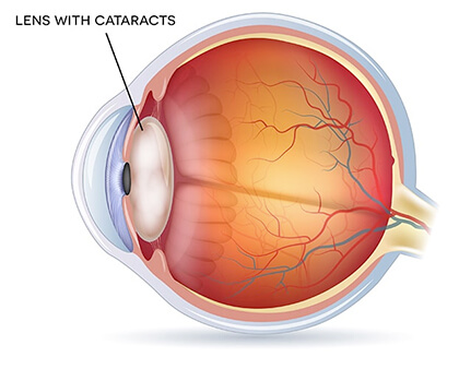 Lens with Cataracts Medical Illustration